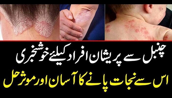 Home-Remedies-to-Get-Rid-of-Psoriasis