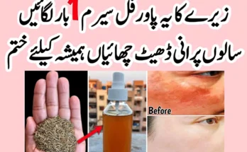 Pigmentation-and-Melasma-Treatment-Home-Remedy