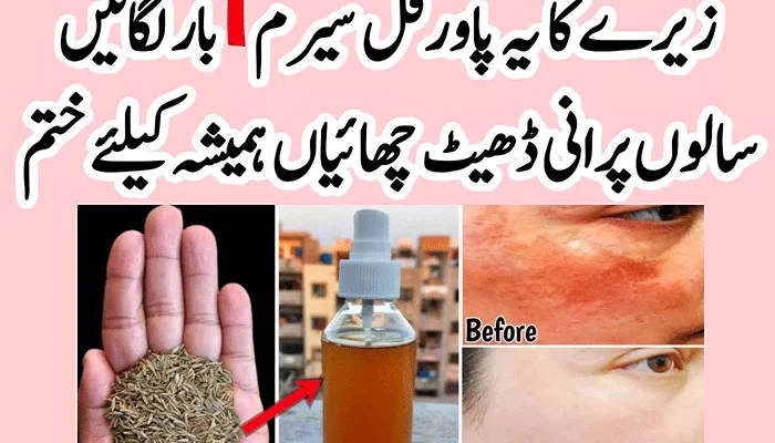 Pigmentation-and-Melasma-Treatment-Home-Remedy