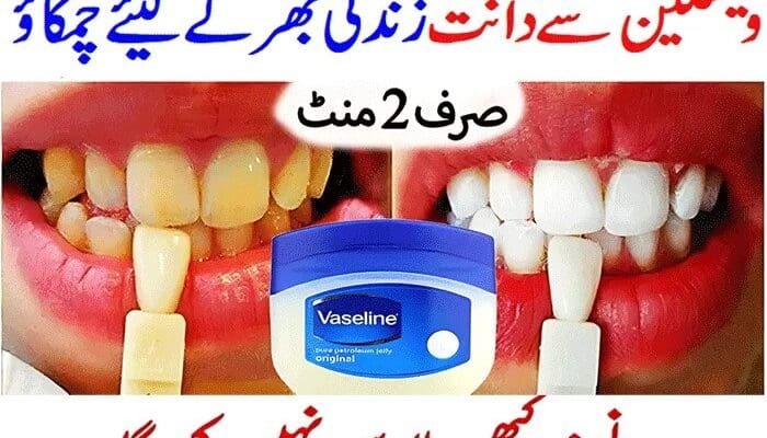 Teeth-Cleaning-Home-Remedy